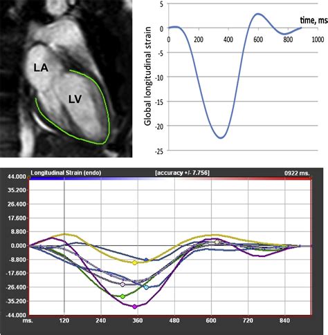 volan 15.6 lv|Normal ranges of left ventricular strain: a meta.